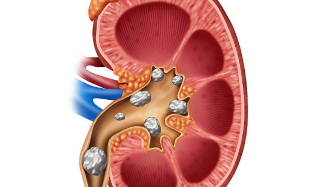 أنجح الطرق للتخلص من حصوات الكلي