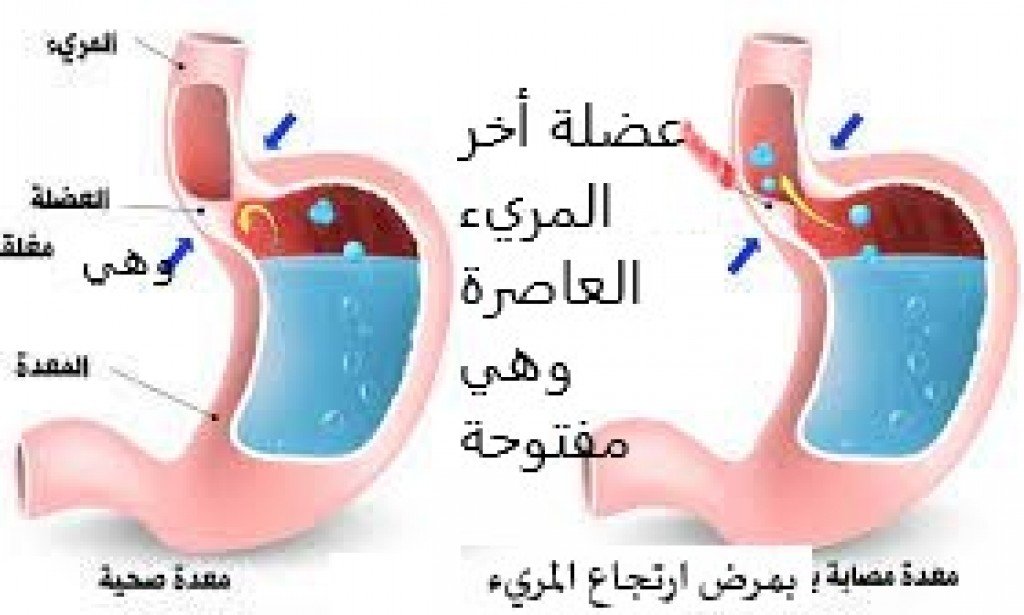 فسيولوجيا ارتجاع المريء | عومل وأسباب.. وقاية وعلاج!
