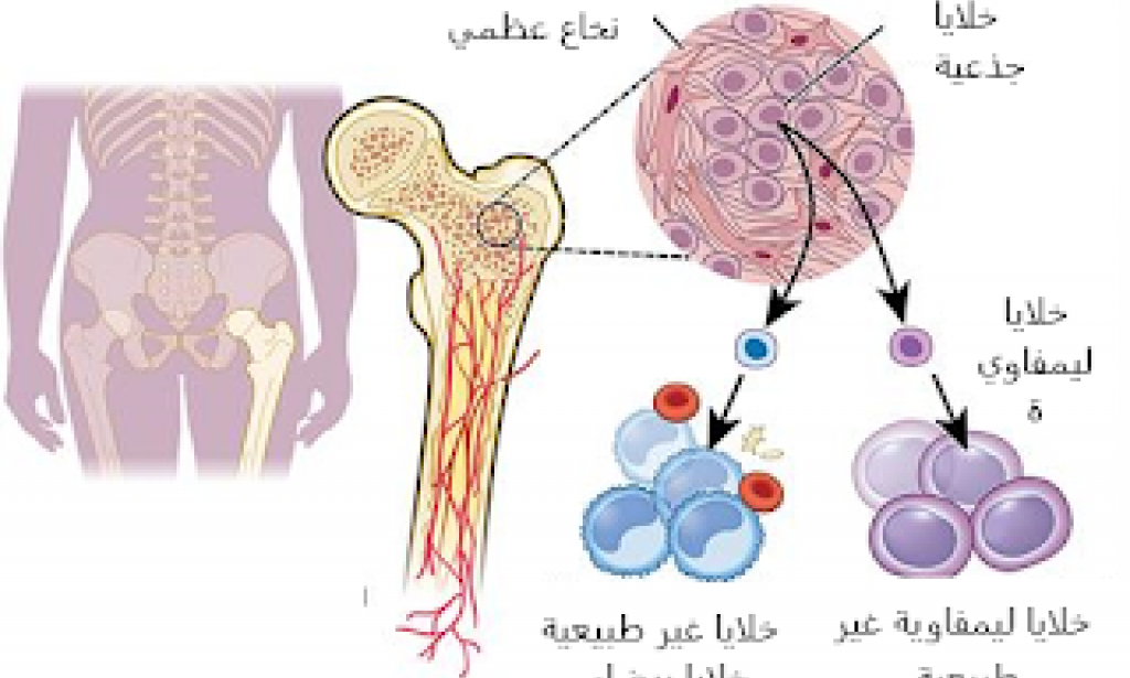 مرض سرطان الدم ( اللوكيميا )! تشخيص وأعراض وعلاج !