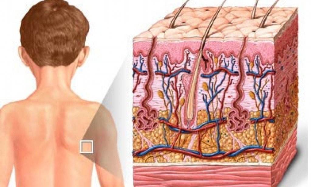 نبذة عن الحروق الجلدية