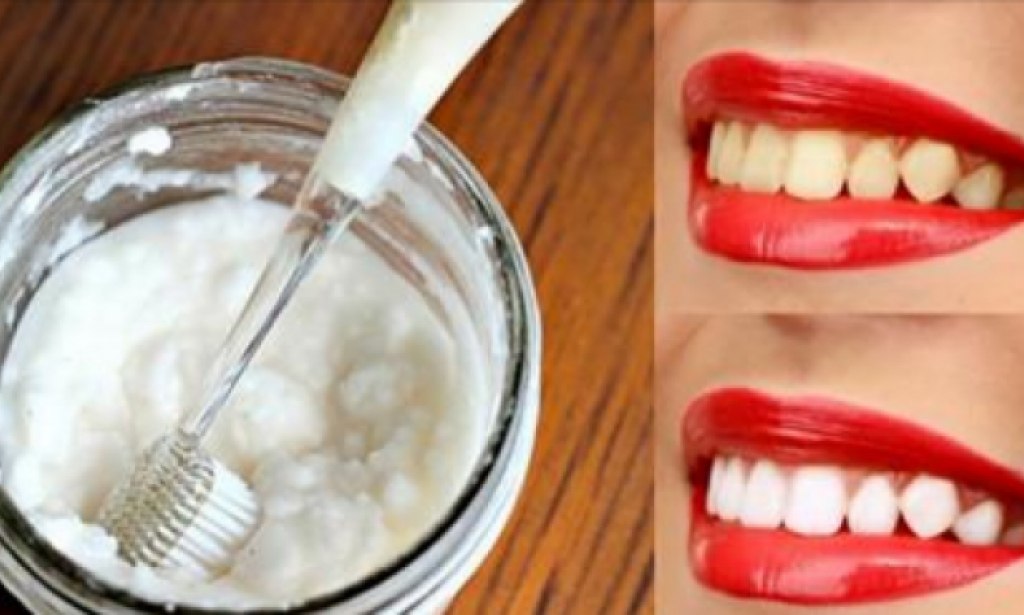 طريقة لتبيض الأسنان كالثلج