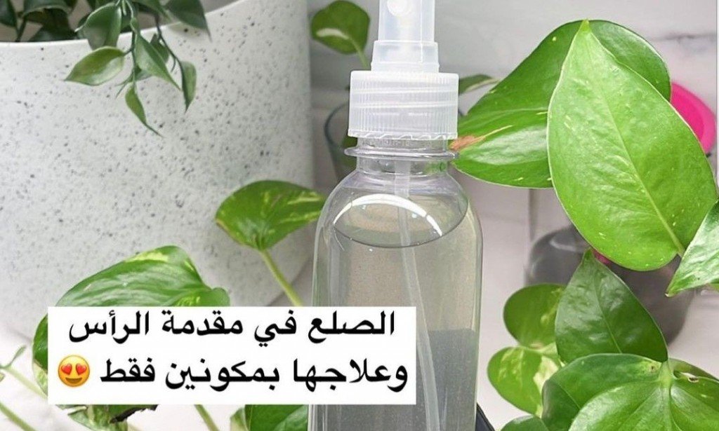 علاج الصلع بمكونين فقط