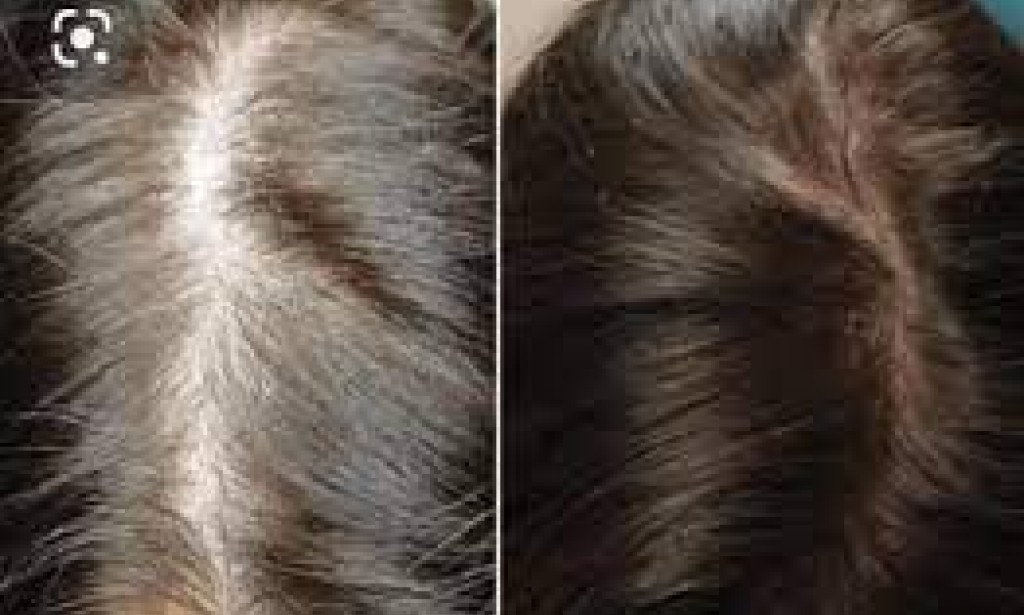 كل شيء عن علاج تساقط الشعر