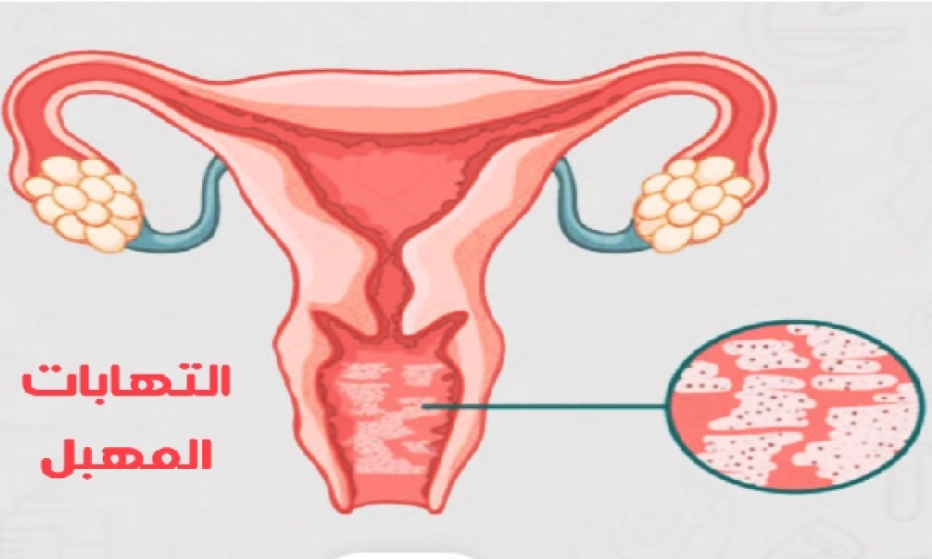 روشتة لعلاج التهابات المهبل