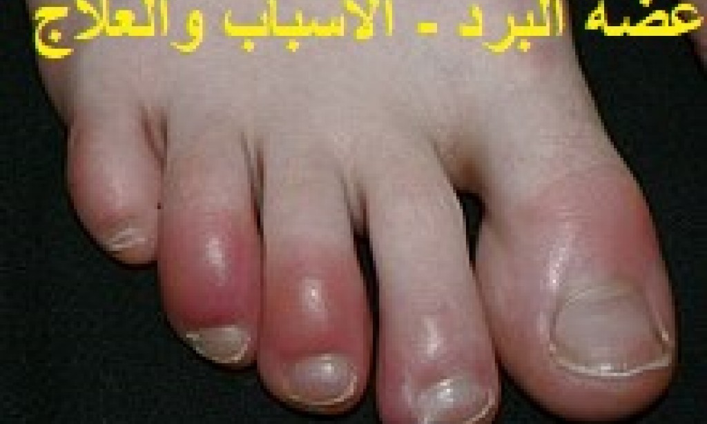 عضة البرد - اسبابها - اعراضها - والوقاية منها وعلاجها