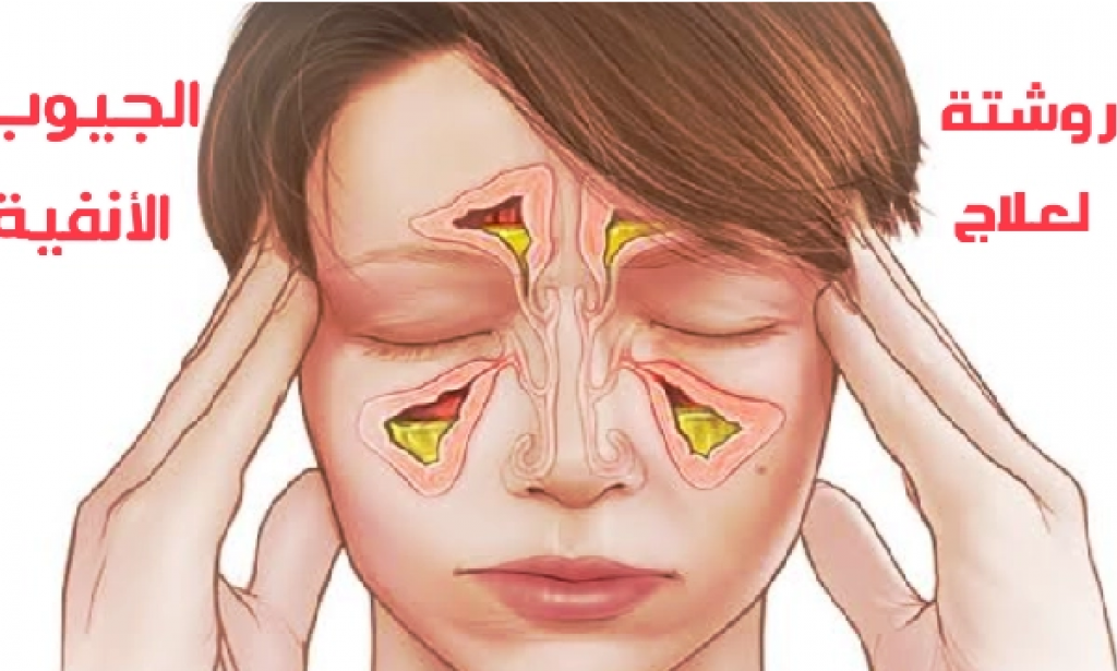 روشتة لعلاج الجيوب الأنفية