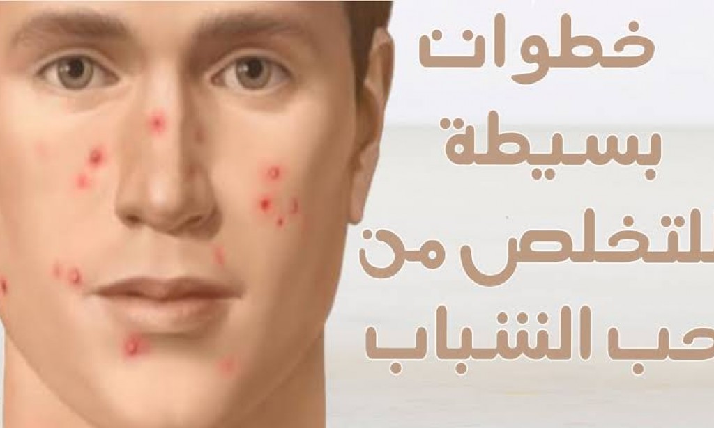 أفضل ماسكات طبيعية للتخلص من حب الشباب