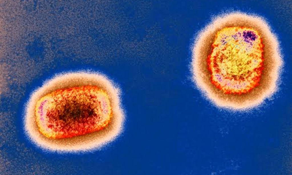 أول إصابة بشرية بجدرى القرود