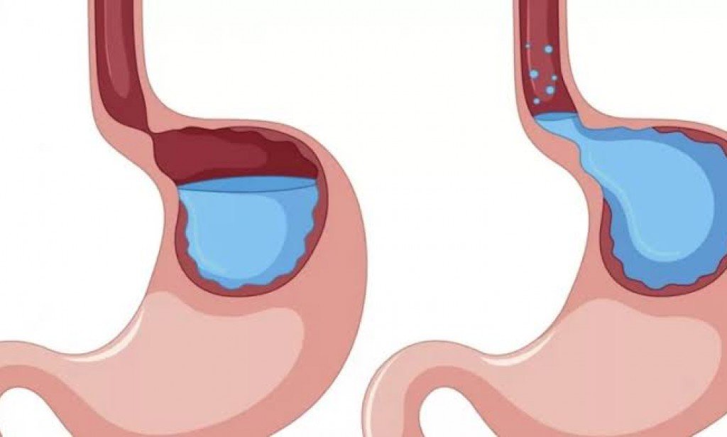 أسباب ارتجاع المريء وطرق علاجه