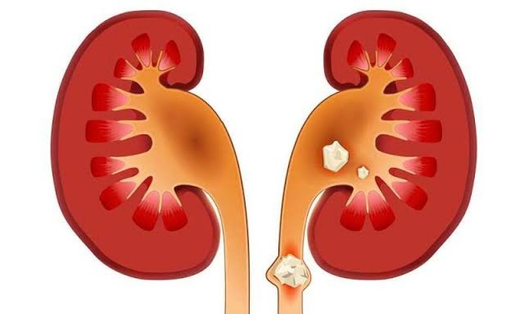 إذابة حصوات الكلى بالأعشاب