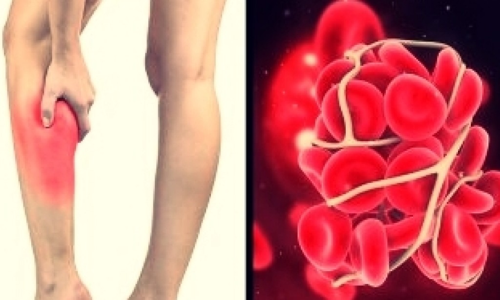 نصائح لمنع تجلط الدم في الجسم