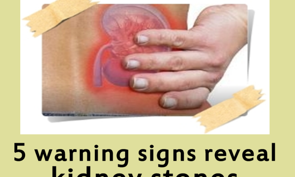 5 warning signs reveal kidney stones