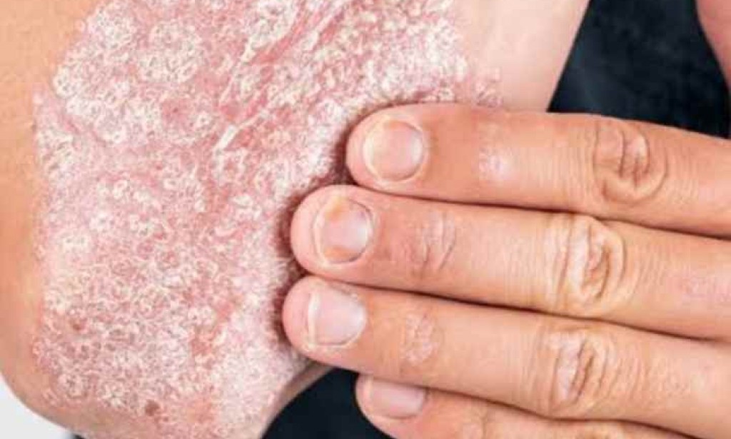 علاج الصدفية بالأعشاب