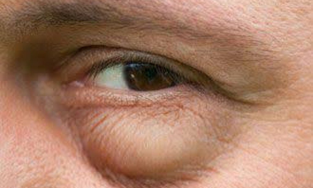 اليكم أهم أسباب تورم جفن العين