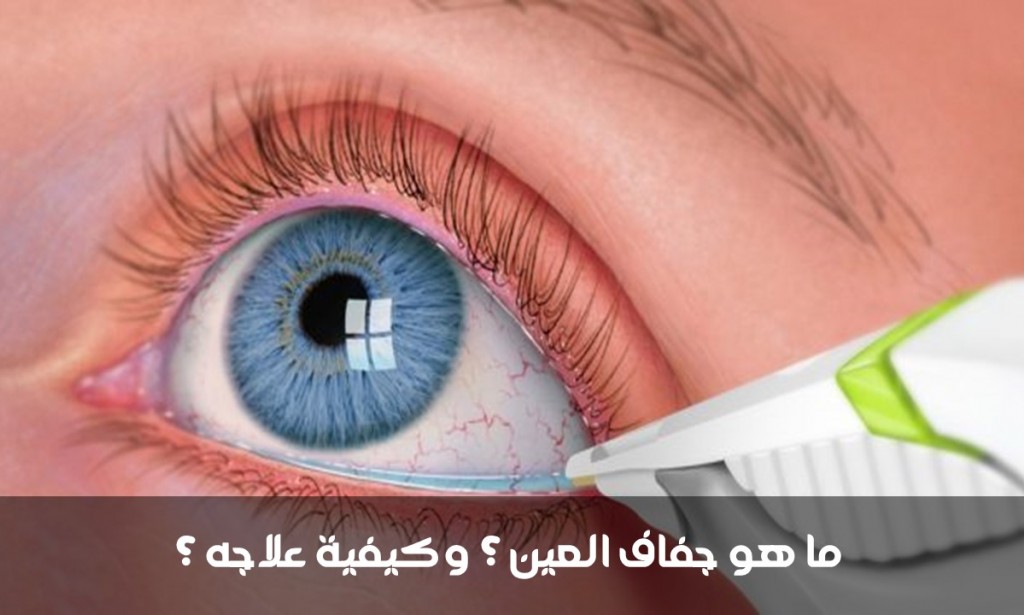 ما هو جفاف العين ؟ وكيفية علاجه ؟