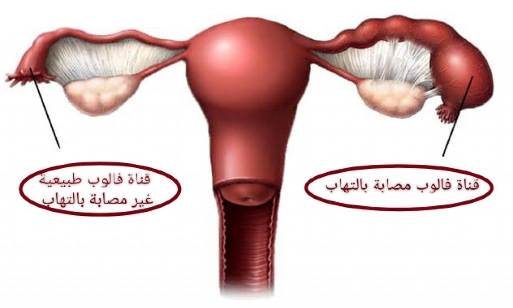 أفضل مضاد حيوي لعلاج التهاب الحوض