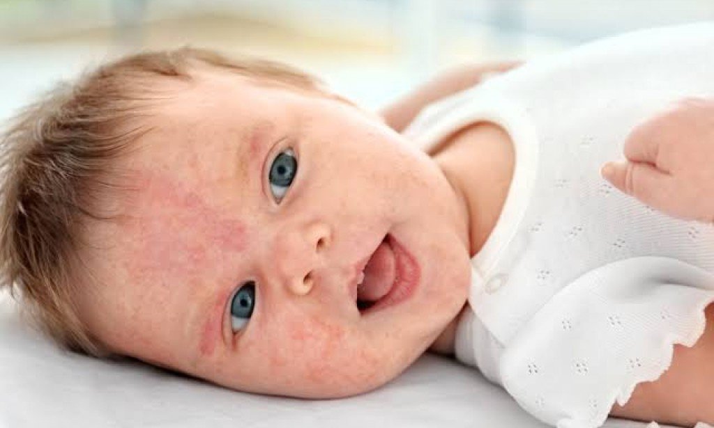 حساسية الالبان عند الرضع وأهم أعراضه وطرق العلاج