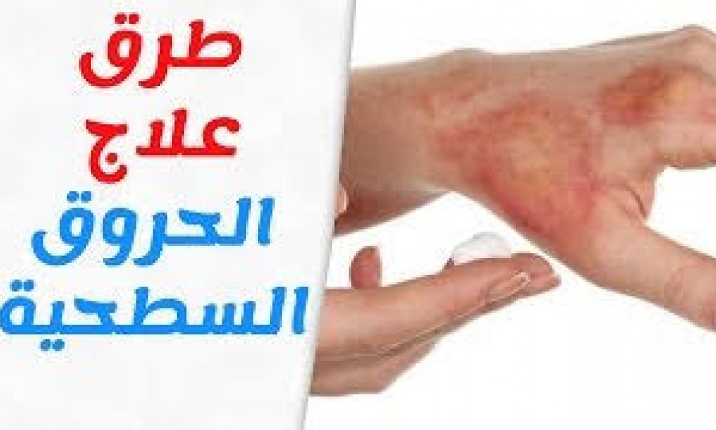 اهم طرق علاج الحروق