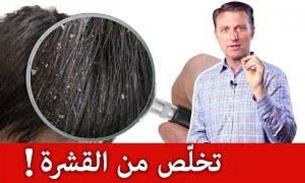 كيفية التخلص من قشرة الشعر بشكل نهائي؟