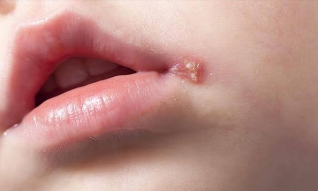 هل هربس الأطفال معدي للحامل