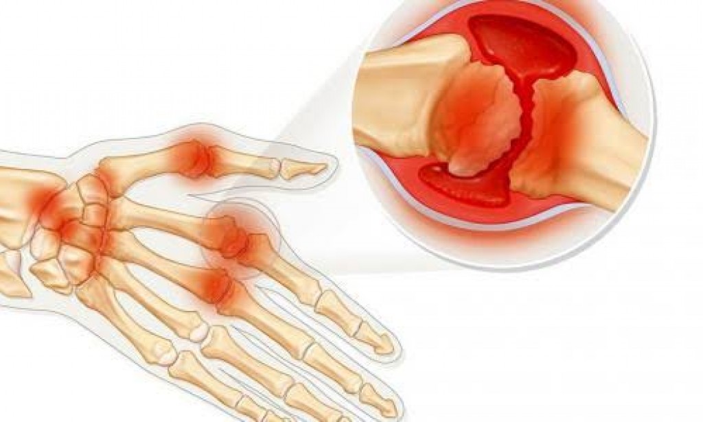 التهاب المفاصل الروماتويدي