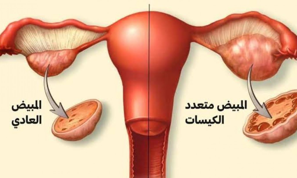 ما هي متلازمة تكيس المبايض وما أعراضها وطرق الوقاية منها