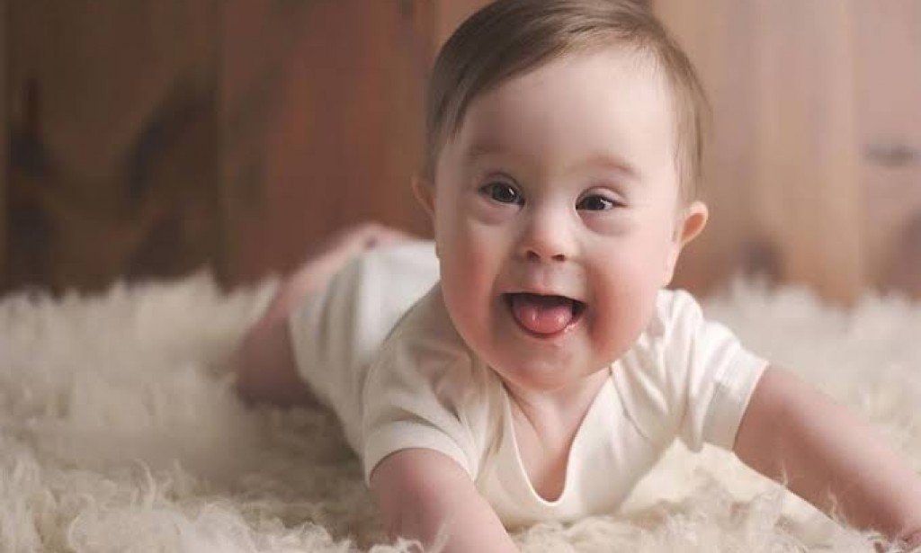 متلازمة داون أسبابها وطرق علاجها