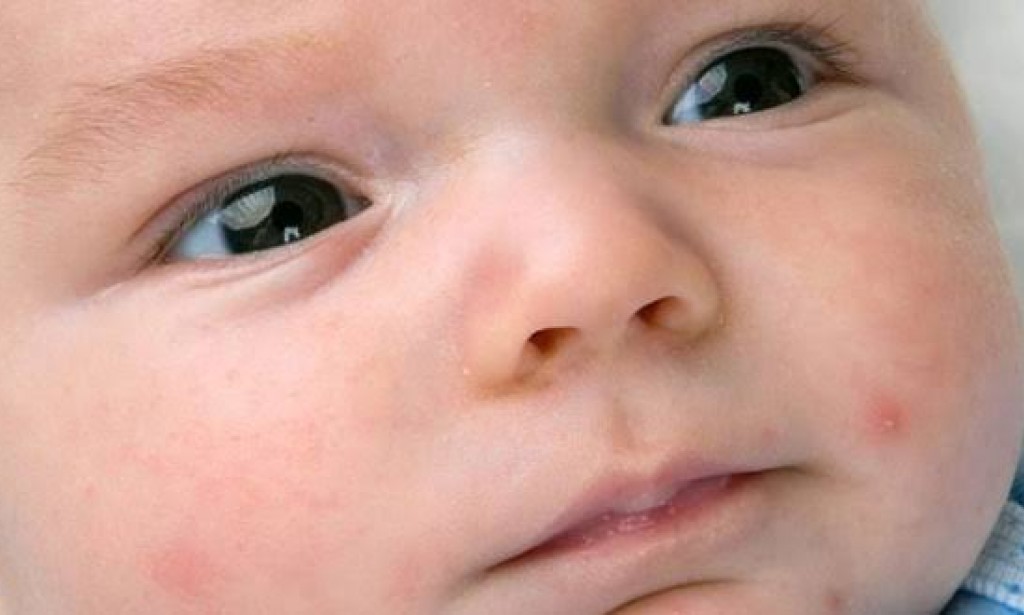 كريم لعلاج حب الشباب للأطفال