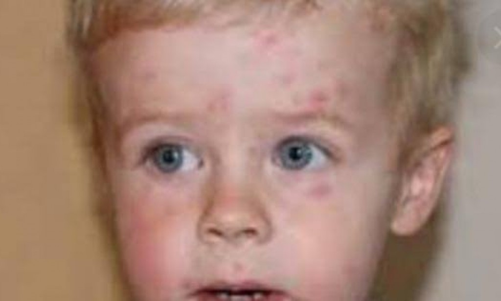 متى تكون البقع البنية خطيرة