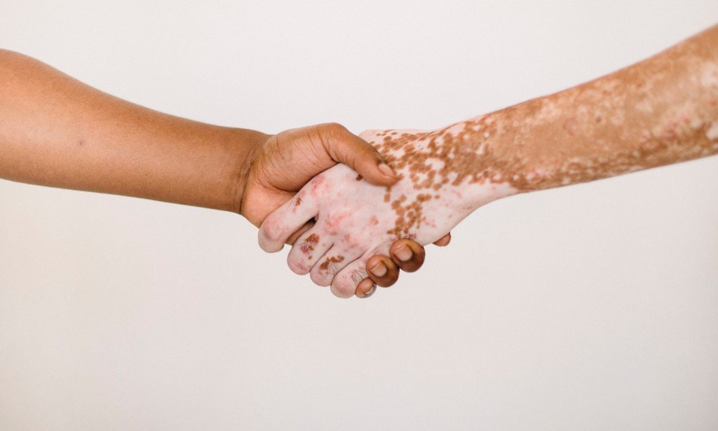 ما هي أسباب الإصابة بالبهاق وما هي أعراضه وطرق علاجه؟