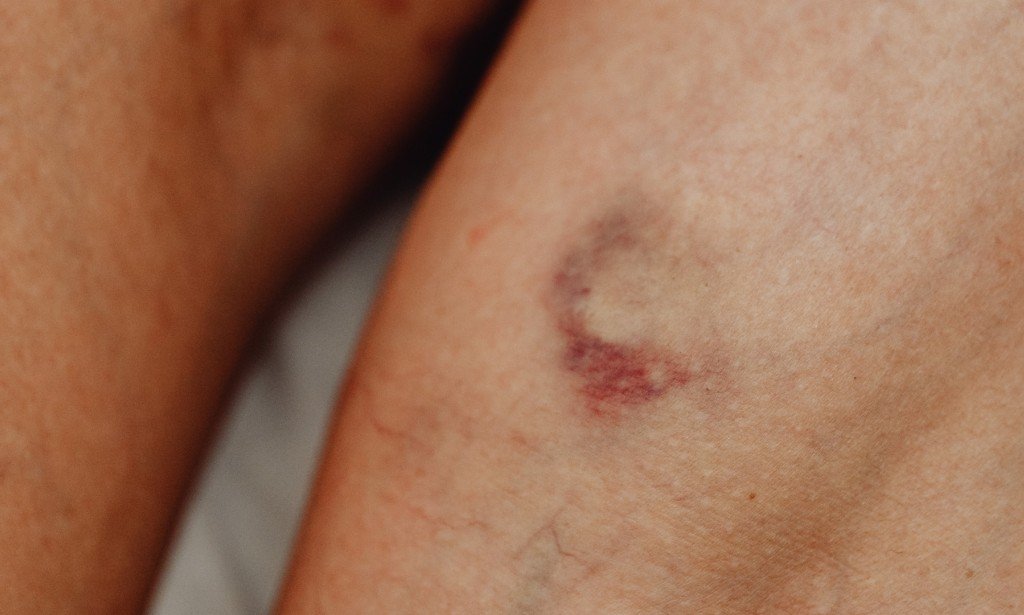 أسباب ظهور الكدمات المفاجئة في الجسم