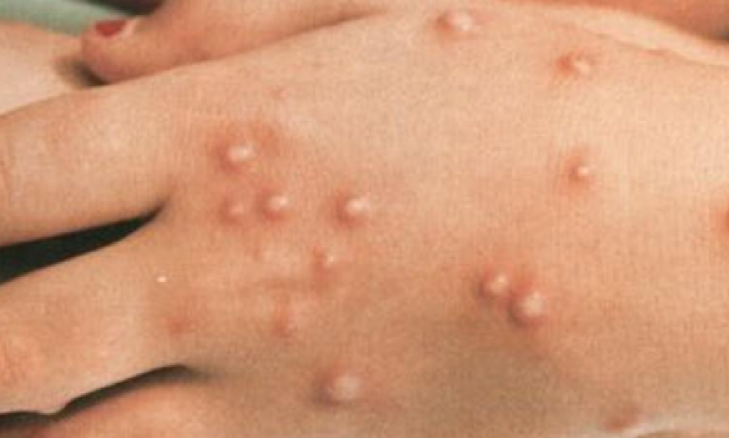 مرض جدرى القرود