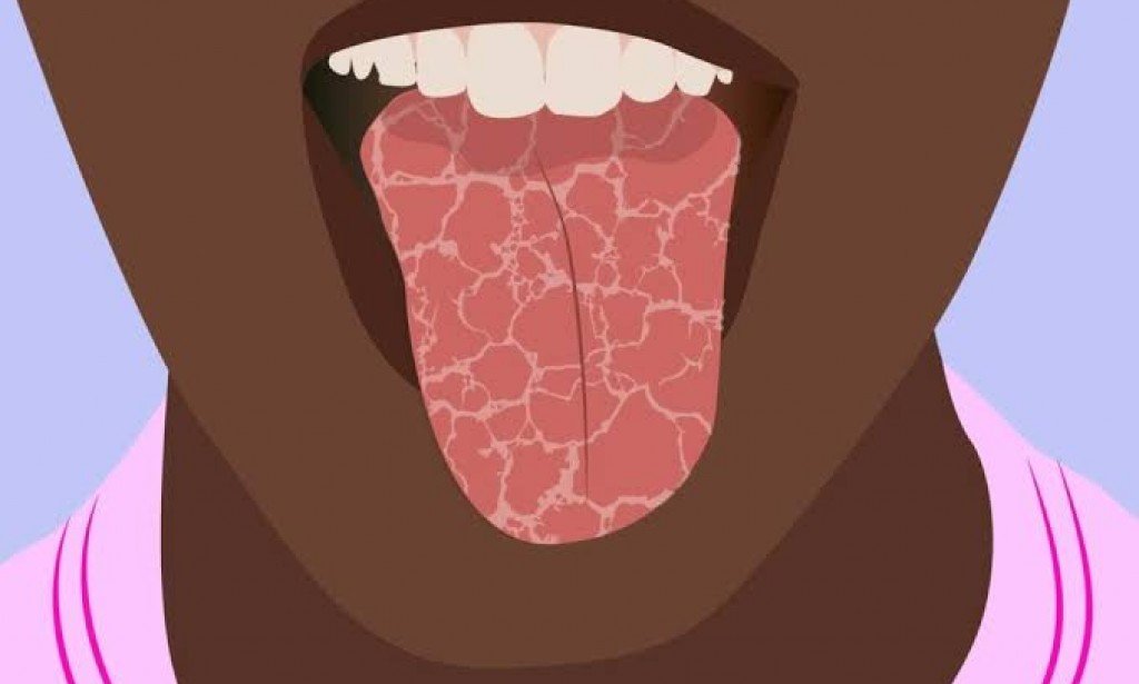 أسباب تشقق اللسان وكيفية علاجها بشكل طبيعي