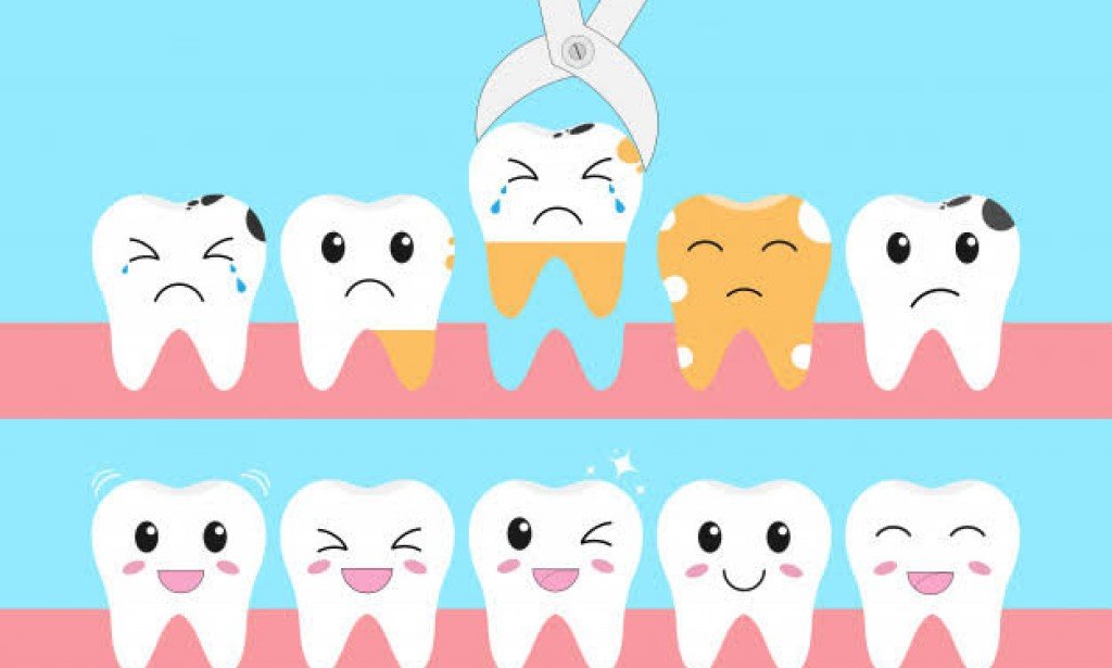 ما هي اسباب تسوس الاسنان وكيفية علاجها