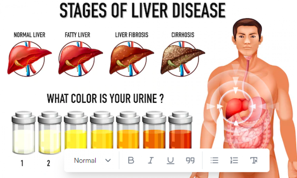 10 Warning Signs That Your Fatty Liver Is Getting Worse - How To Catch It Early