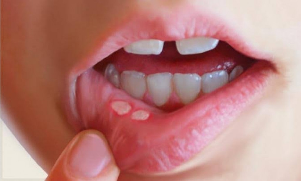 ?Mouth Ulcers: When Will They Disappear