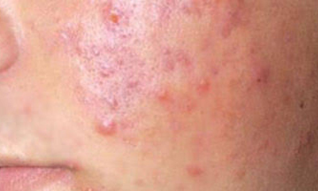 أسباب ظهور حب الشباب حتى بعد العلاج