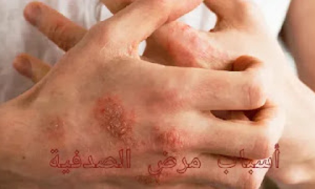 أسباب مرض الصدفية وعوامل الخطر التي يجب تجنبها