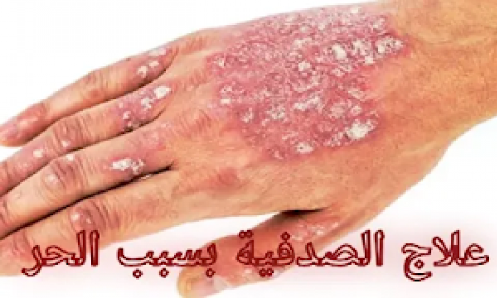 5 طرق للتغلب على أعراض الصدفية بسبب الطقس الحار