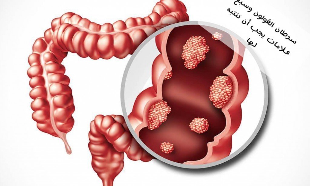 سرطان القولون وسبع علامات يجب أن تنتبه