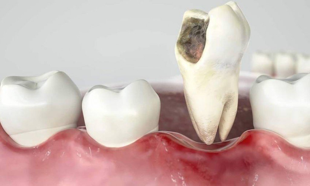 نصائح للشفاء بعد جراحة اللثة