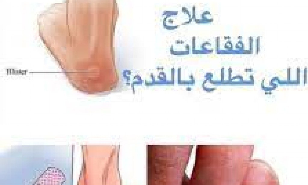 علاج فقاعات القدم السكري وطرق الوقاية منها بالتفصيل