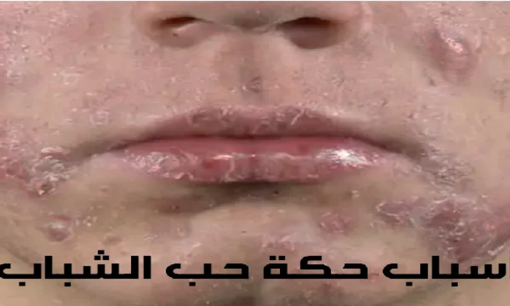 5 أسباب لحكة حب الشباب وعدم الراحة