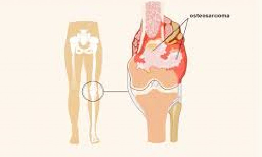 A Comprehensive Guide to Bone Cancer: Types, Symptoms, and Treatment Options