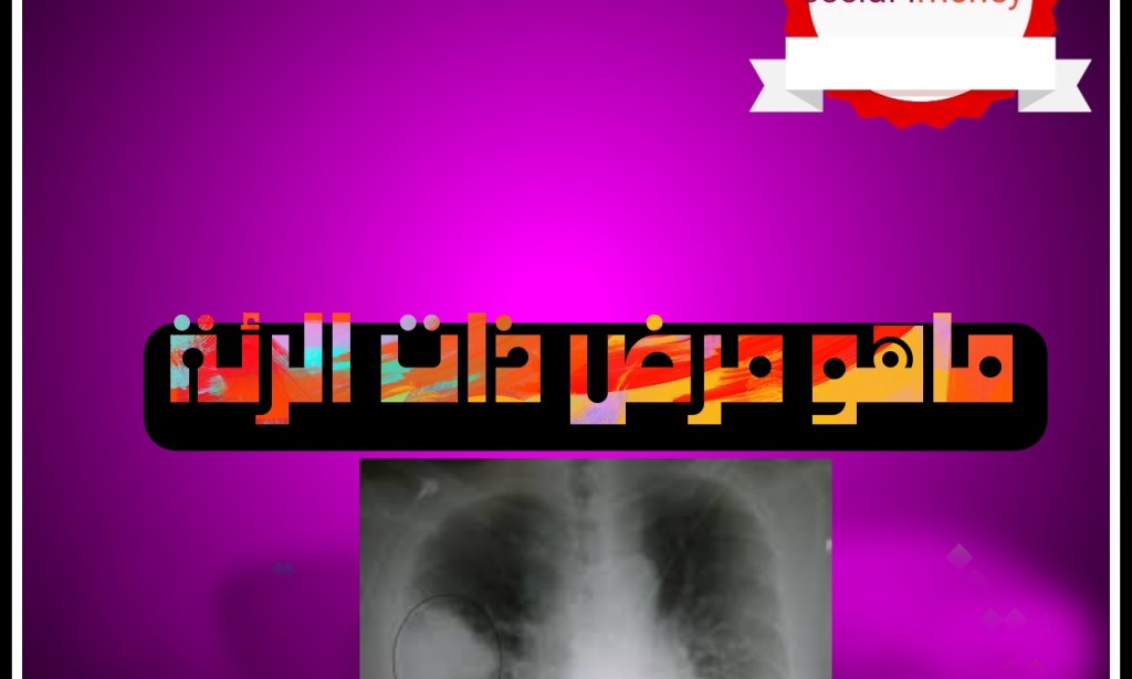 ماهو مرض ذات الرئة