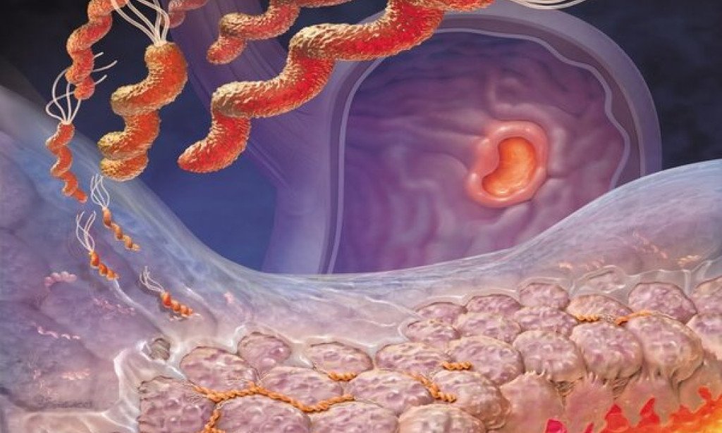 جرثومة المعدة : الخطوة الأولى في الكشف المبكر عن التهاب وقرحة المعدة